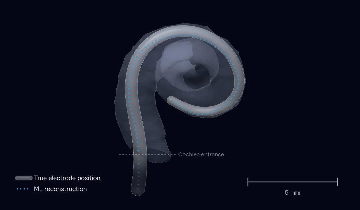 Software-rendered view of a cochlea with an electrode array inserted through its basal turn: the true array position and the machine-learning reconstruction from the sensors lie almost on top of each other along the whole insertion; a 5 millimeter scale bar.